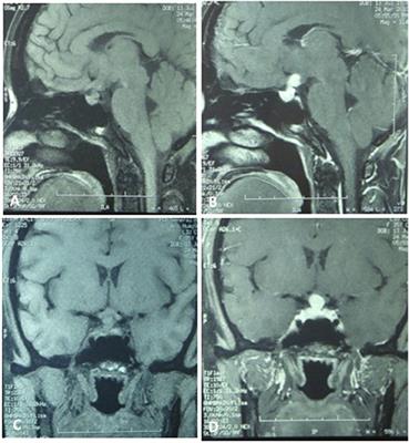A Craniopharyngioma Associated With Elevated Cerebrospinal Fluid HCG Concentrations Misdiagnosed as a Germinoma